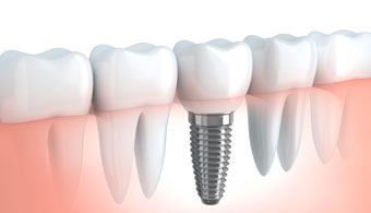 Dental Implants