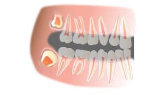 Wisdom-Teeth-Treatment