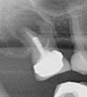 root-canal-xray