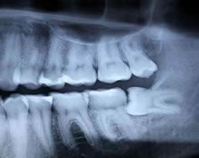 best wisdom teeth removal in Berwick