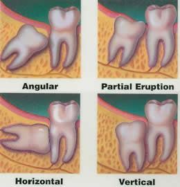 Wisdom Teeth Removal