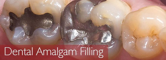 Dental Amalgam Filling