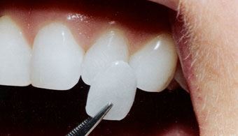 Dental Veneers Treatments by Dentist Lynbrook