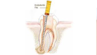 Easy Root Canal Therapy