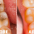 How to Reverse Tooth Decay?