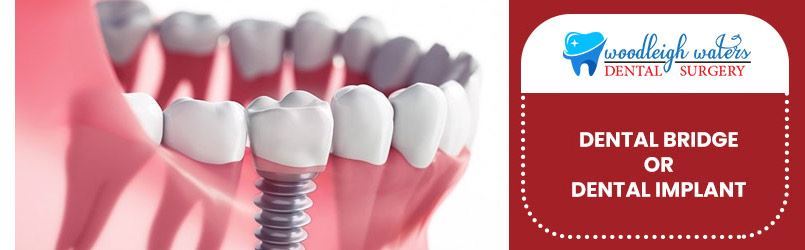 Dental Bridge Or Dental Implant