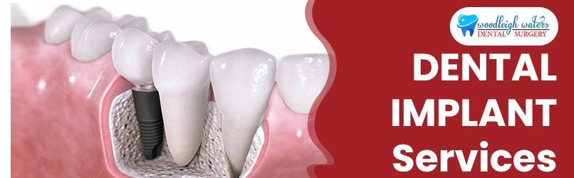 Dental Implant Services