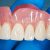 Things You Need to Avoid During Dentures