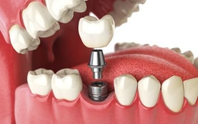 Dental-Implants-in-Clyde-North