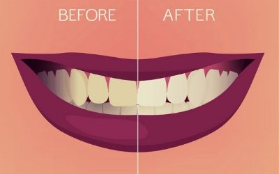 Teeth Whitening By Hampton Park Dentist