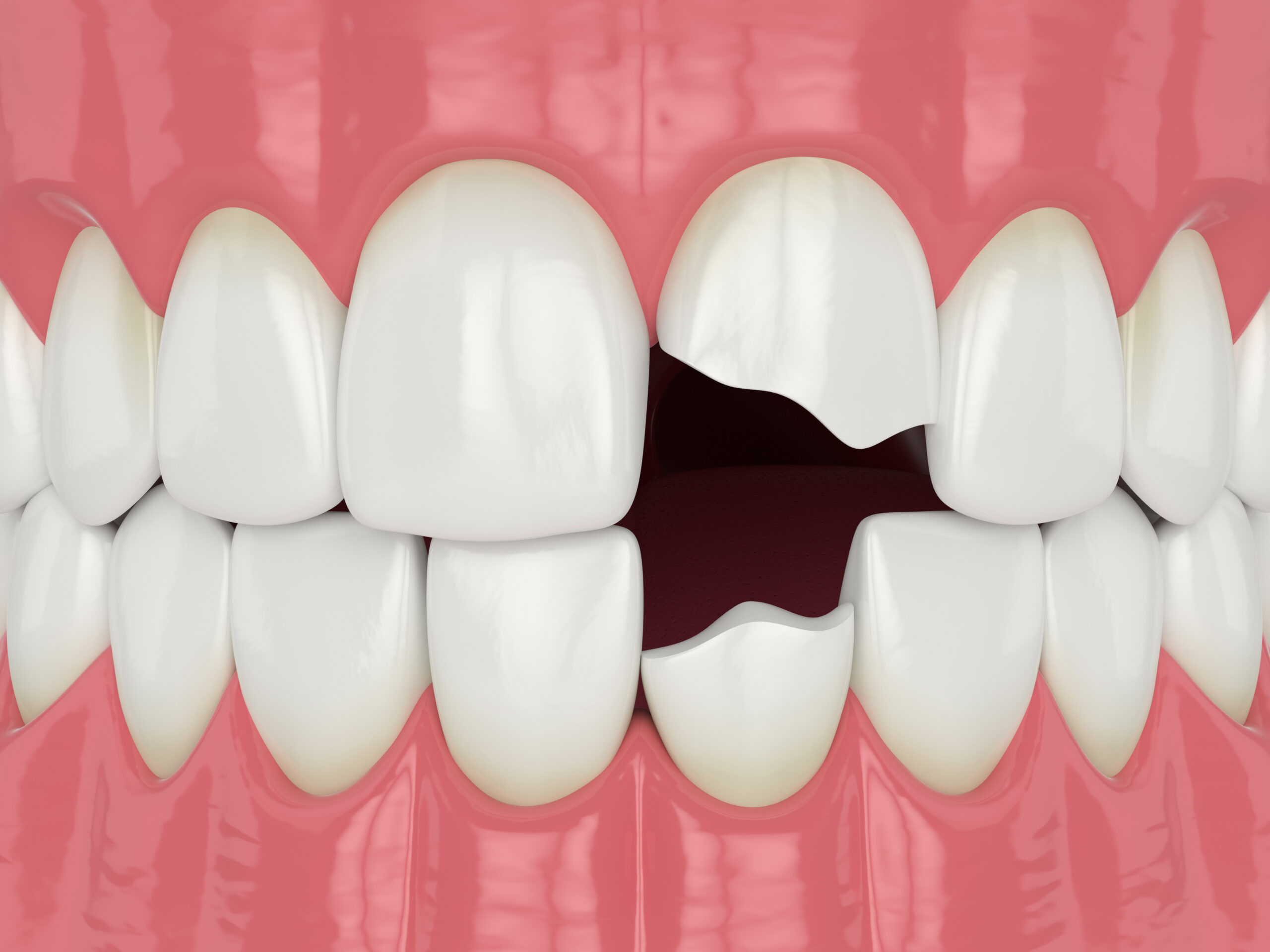7 Best Options to Fix a Broken Tooth - Dental Direkt