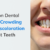 Common Dental Issues: Crowding and Discoloration of Front Teeth