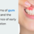 Symptoms of Gum Disease and the Importance of Early Intervention