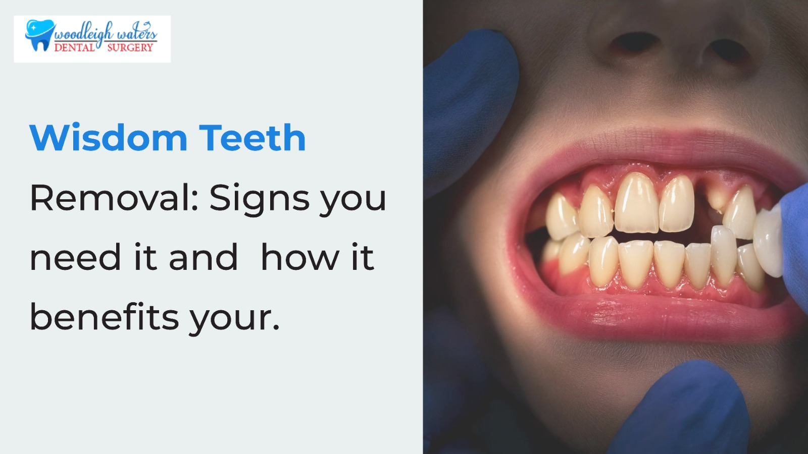 Wisdom Teeth Removal: Signs you need it and  how it benefits you