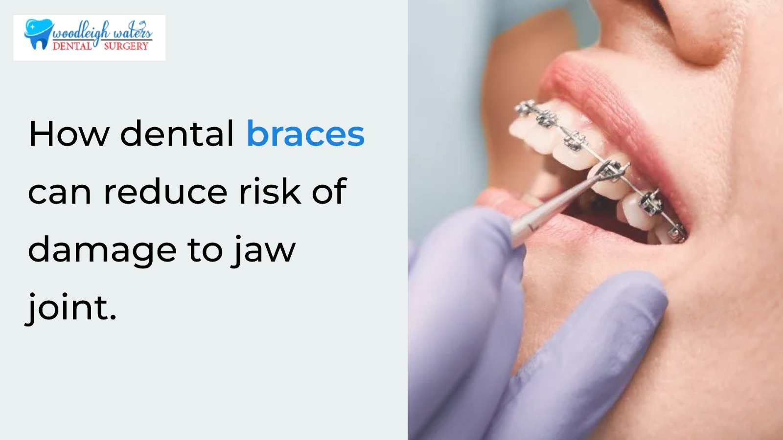 How Dental Braces Can Reduce Risk of Damage to Jaw Joint